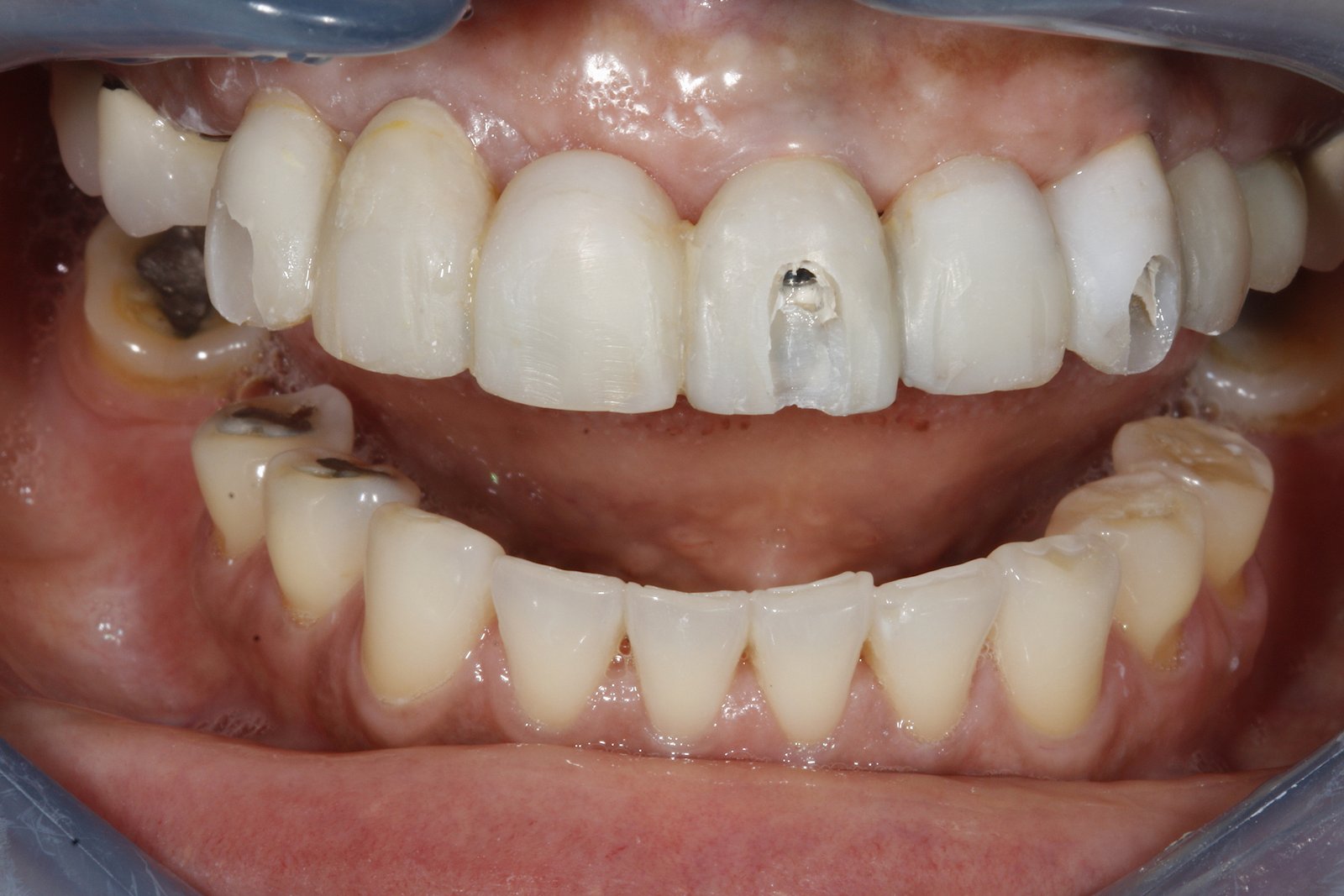 With provisional restorations