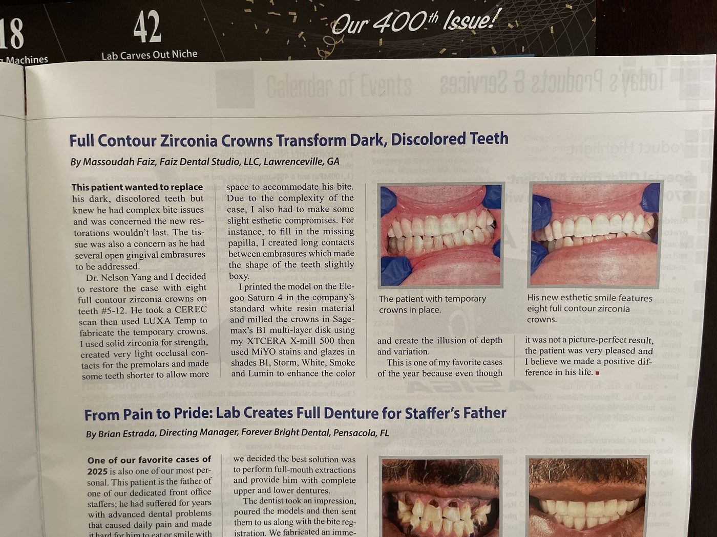 Full Contour Zirconia Crowns case study by Massoudah Faiz
